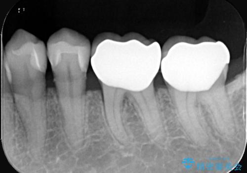 セラミックで叶える集中審美治療の治療後