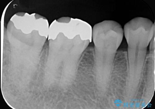 銀歯の下の虫歯|オールセラミッククラウン|歯を長持ちさせるための治療|歯の神経を守るの治療前
