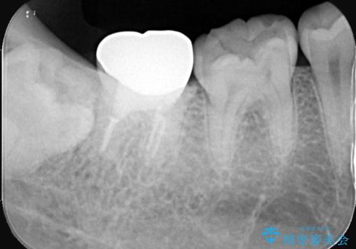 銀歯を白くしたい|オールセラミッククラウンの治療前