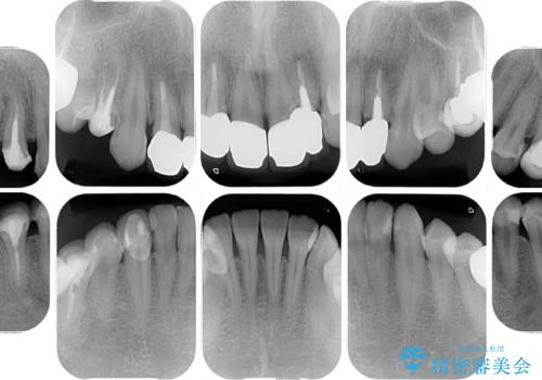 以前の治療箇所が痛む 全顎的なむし歯治療の治療前
