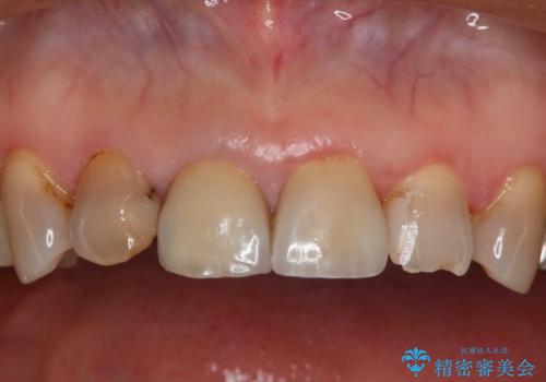 前歯を綺麗にしたい オールセラミッククラウンの治療前