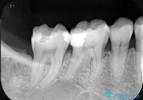 奥歯を美しくセラミック修復の治療前