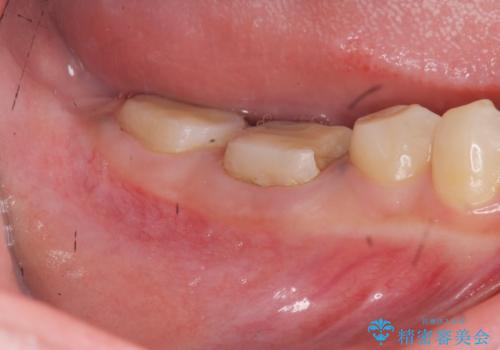 歯冠長延長術・骨隆起除去を行った、スペースの少ないセラミック治療の治療中