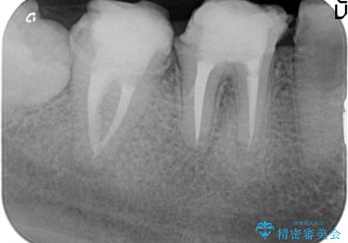 歯冠長延長術・骨隆起除去を行った、スペースの少ないセラミック治療の治療中