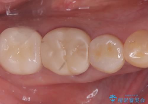 【セラミッククラウン】銀歯を白くしたいの治療後