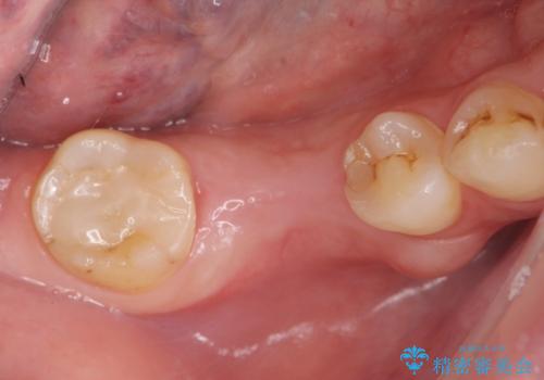 審美性に優れるノンクラスプデンチャーの治療前