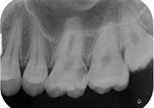 親知らずのご相談で虫歯発見　セラミックインレーの治療前