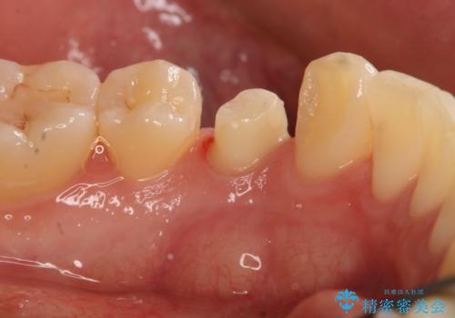 セラミックの被せ物を入れたい フルジルコニアクラウンの治療中