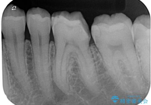 詰め物が割れたのでやり替えたい オールセラミッククラウンの治療前
