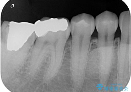 メタルフリー治療 虫歯になりにくいセラミックインレーへの治療前