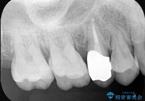 被せ物の黒ずみを美しく改善の治療後