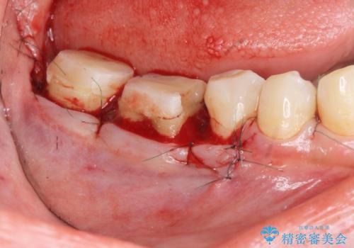 歯冠長延長術・骨隆起除去を行った、スペースの少ないセラミック治療の治療中