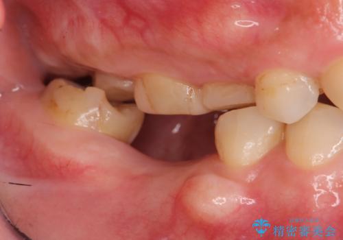 審美性に優れるノンクラスプデンチャーの治療前