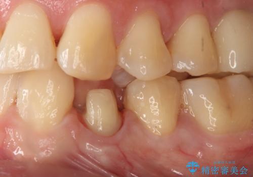 セラミックの被せ物を入れたい フルジルコニアクラウンの治療中