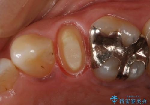 歯ぐきが腫れた　フルジルコニアクラウンの治療中