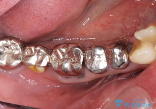 多数の銀歯と虫歯、セラミック・インプラント治療の治療前