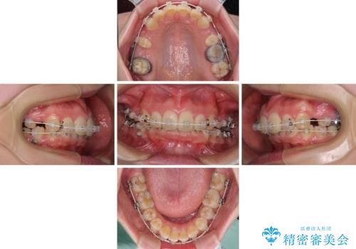 飛び出した前歯 抜歯矯正で横顔が劇的変化の治療中