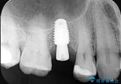 低侵襲なインプラント|痛くないインプラント|エンドペリオ病変|虫歯治療|セラッミクインレーの治療中
