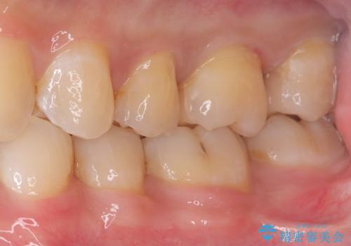 【セラミックインレー】虫歯がないか確認してほしいの治療後