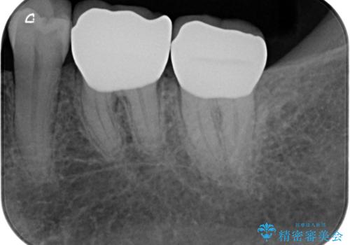[ 歯周病治療 ]  無症状に進行した歯周病、歯周外科を用いたセラミック治療の治療後