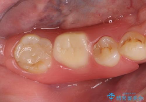 審美性に優れるノンクラスプデンチャーの治療後
