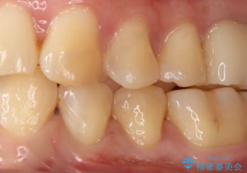 セラミックの被せ物を入れたい フルジルコニアクラウンの治療前