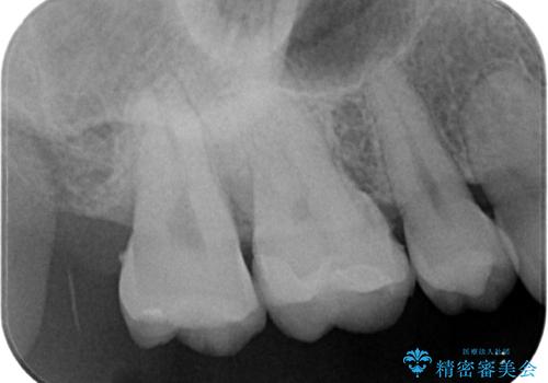 金属の詰め物がとれたので虫歯治療をしたい セラミックインレー修復の治療後
