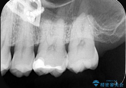 【セラミックインレー】虫歯がないか確認してほしいの治療前