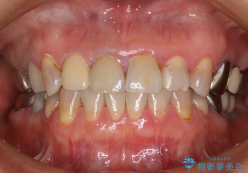 前歯を綺麗にしたい オールセラミッククラウンの症例 治療後