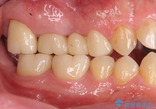 奥歯ブリッジの症例 治療後