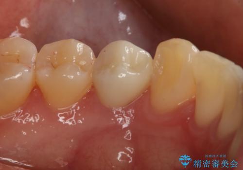 セラミックの被せ物を入れたい フルジルコニアクラウンの治療後