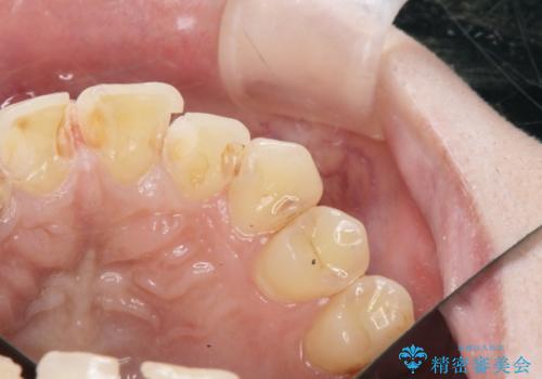 充填物の変色を繰り返す前歯のセラミック治療の治療中