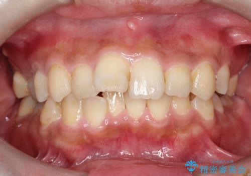 【ワイヤー矯正】前歯の凸凹を治したいの治療前