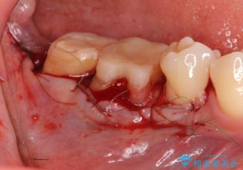 スペース狭小な銀歯を白くしたい 歯冠長延長術を併用したセラミック治療の治療中