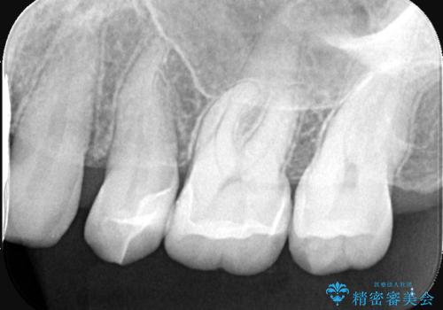 【セラミックインレー】ホワイトニングしに来たら虫歯が見つかったの治療後