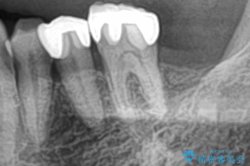 インプラント治療を含む精密審美治療の治療前