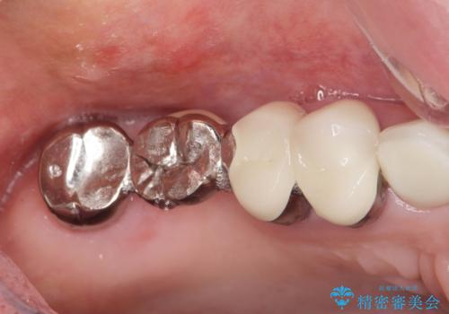 ブリッジのぐらつき インプラントを用いた奥歯の噛み合わせの再構築の治療前