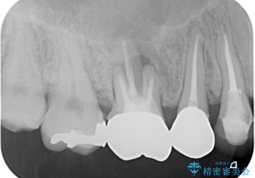 奥歯のインプラント治療の治療前