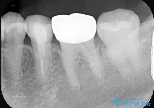 銀歯を白くしたい セラミックインレーの治療後