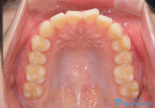 前歯のねじれをマウスピース矯正で治したいの治療前