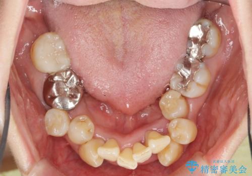 歯周病 、インプラント、 矯正 全顎治療の治療前