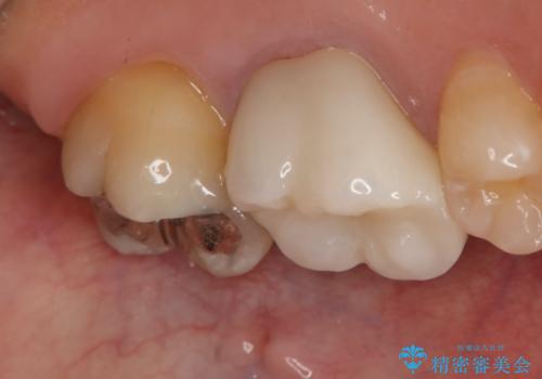 銀歯を白くしたい セラミックインレーの治療前