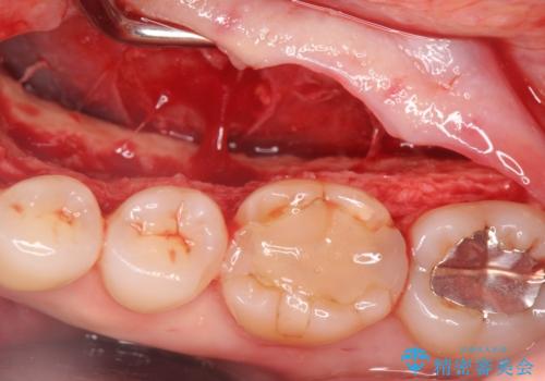 話すのに邪魔な、下顎骨隆起の切除の治療中