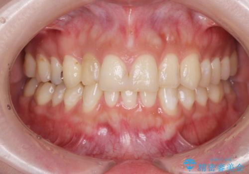 充填物の変色を繰り返す前歯のセラミック治療の治療前