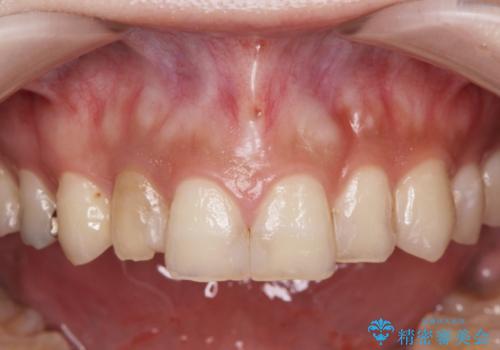 充填物の変色を繰り返す前歯のセラミック治療の治療前