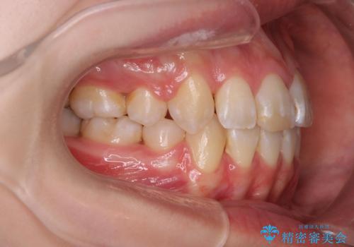 突き出た前歯を治したい 小臼歯抜歯+マルチブラケット矯正の治療後