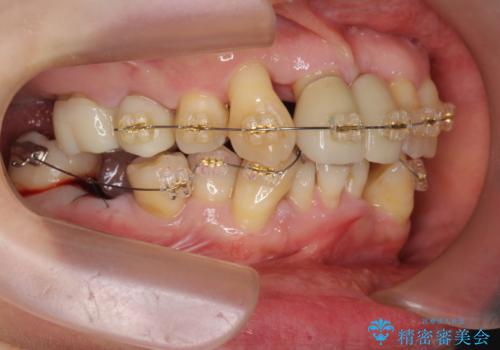 歯周病 、インプラント、 矯正 全顎治療の治療中