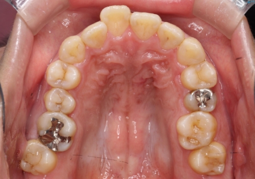 【ワイヤー矯正】前歯の凸凹を治したいの治療前