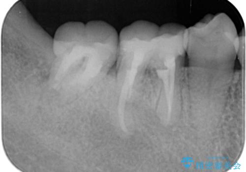 スペース狭小な銀歯を白くしたい 歯冠長延長術を併用したセラミック治療の治療後