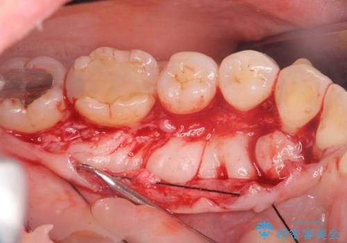話すのに邪魔な、下顎骨隆起の切除の治療中